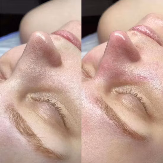 Oxygen Aqua Peel Skin Care Cleaning Hydra Dermabrasion Facial Hydrafacial Machine